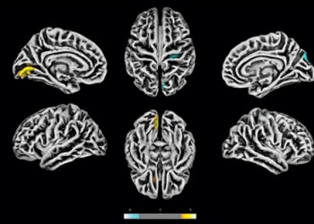 Exames de ressonância magnética feitos na Unicamp em 81 pacientes com sintomas neuropsiquiátricos pós-COVID revelam alterações na estrutura do córtex cerebral. As áreas em amarelo apresentam redução na espessura cortical. As marcas azuis correspondem a áreas com espessura aumentada. Foto: Divulgação/Fapesp